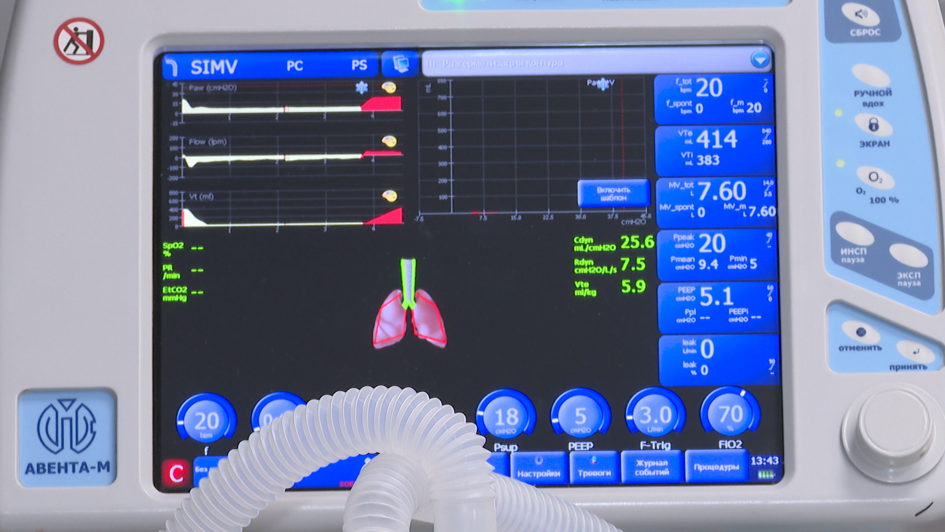 «Достаем тромб из мозга»: в сосудистом центре Волгограда показали, на что способна современная медицина