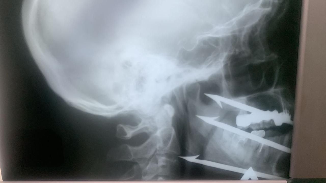 В Волгограде хирурги спасли рыбака, выстрелившего себе в лицо из подводного ружья