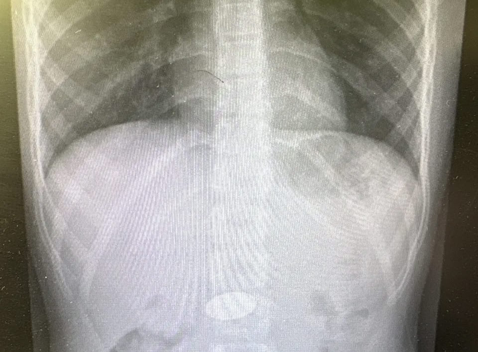 В Волгограде спасли мальчика, проглотившего пятирублевую монету